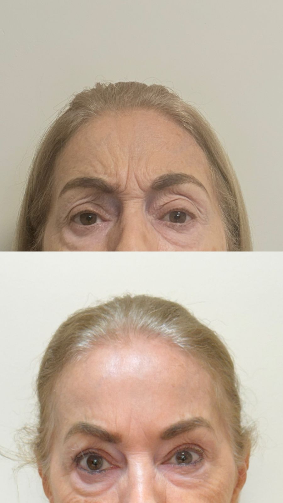 Antes e depois de bioestimulador de colágeno