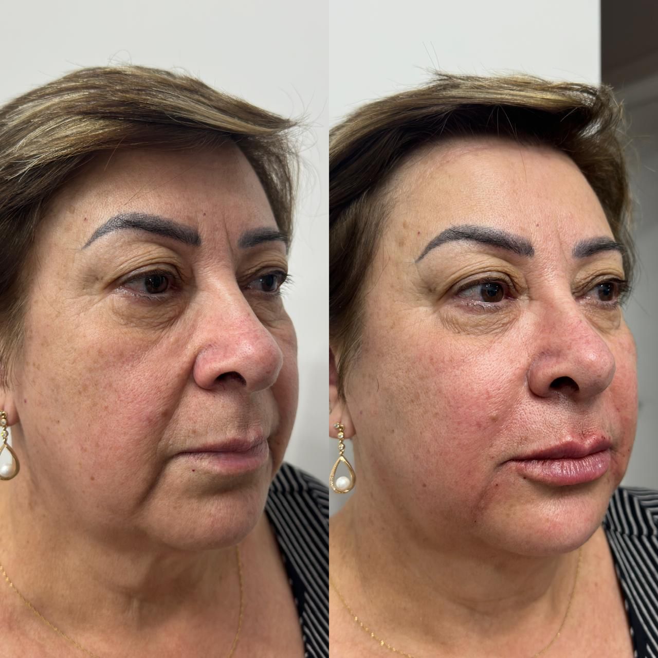 Antes e depois de bioestimulador de colágeno