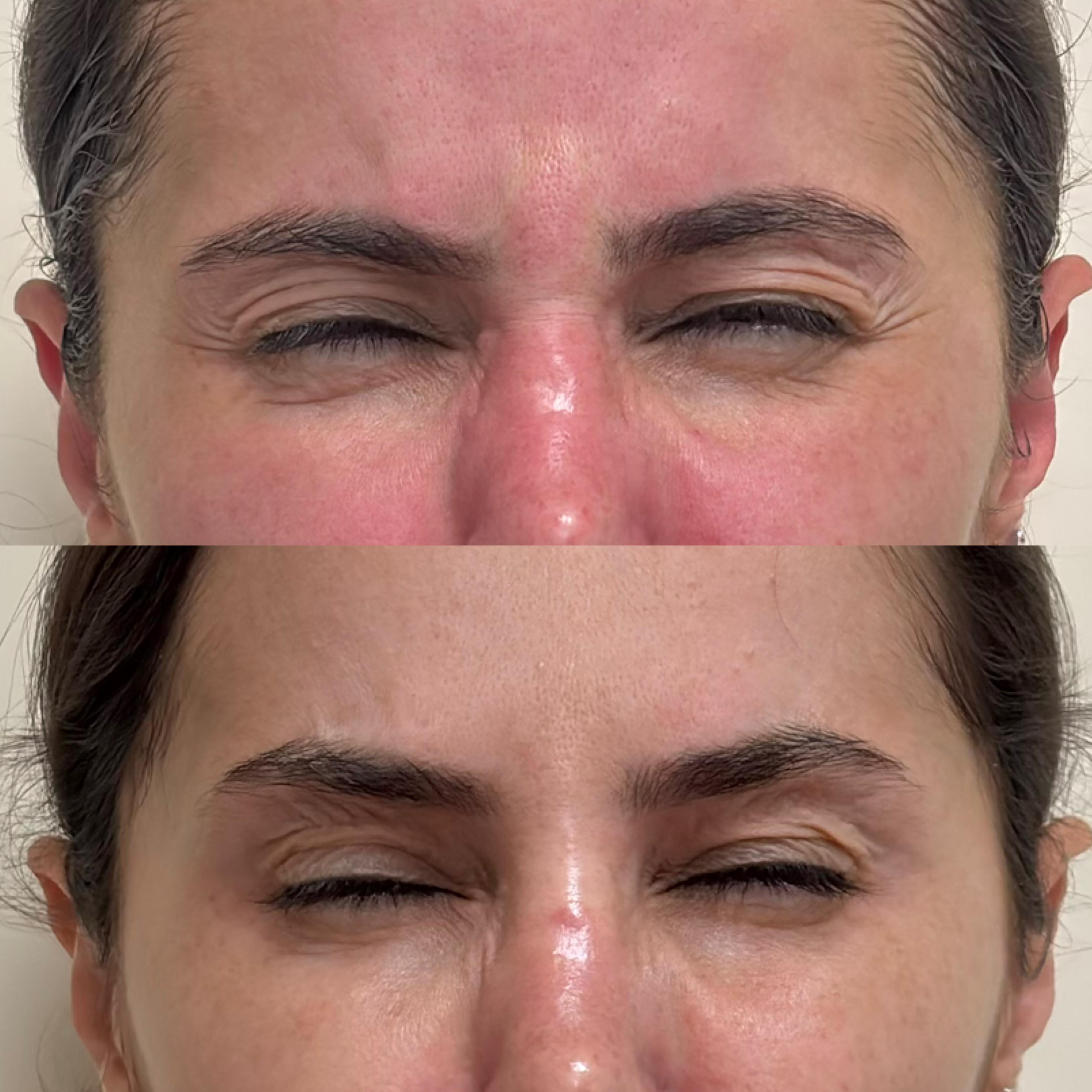 Antes e depois de toxina botulínica na glabela