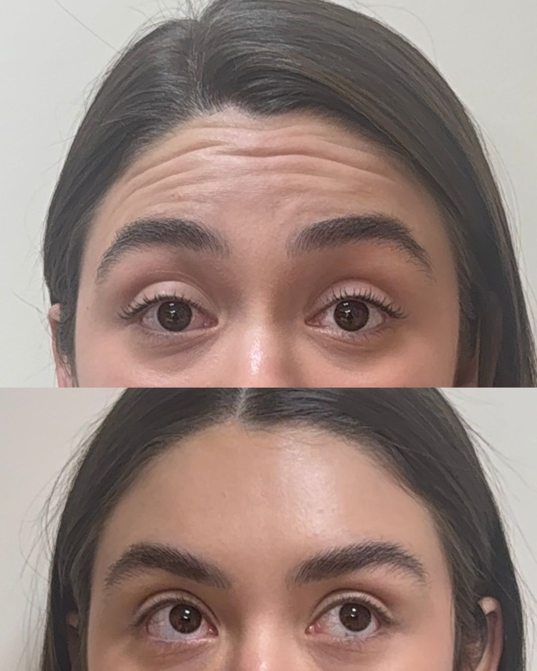Antes e depois de toxina botulínica na testa