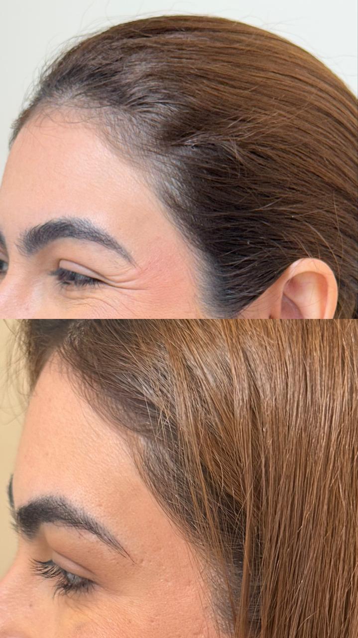 Antes e depois de toxina botulínica nos pés de galinha