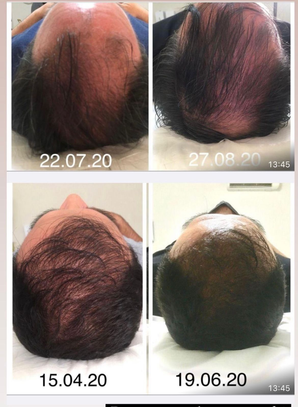 Antes e depois de terapia capilar