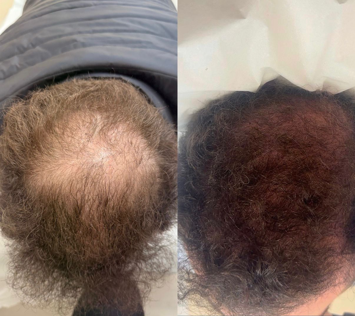 Antes e depois de terapia capilar, aumento de densidade