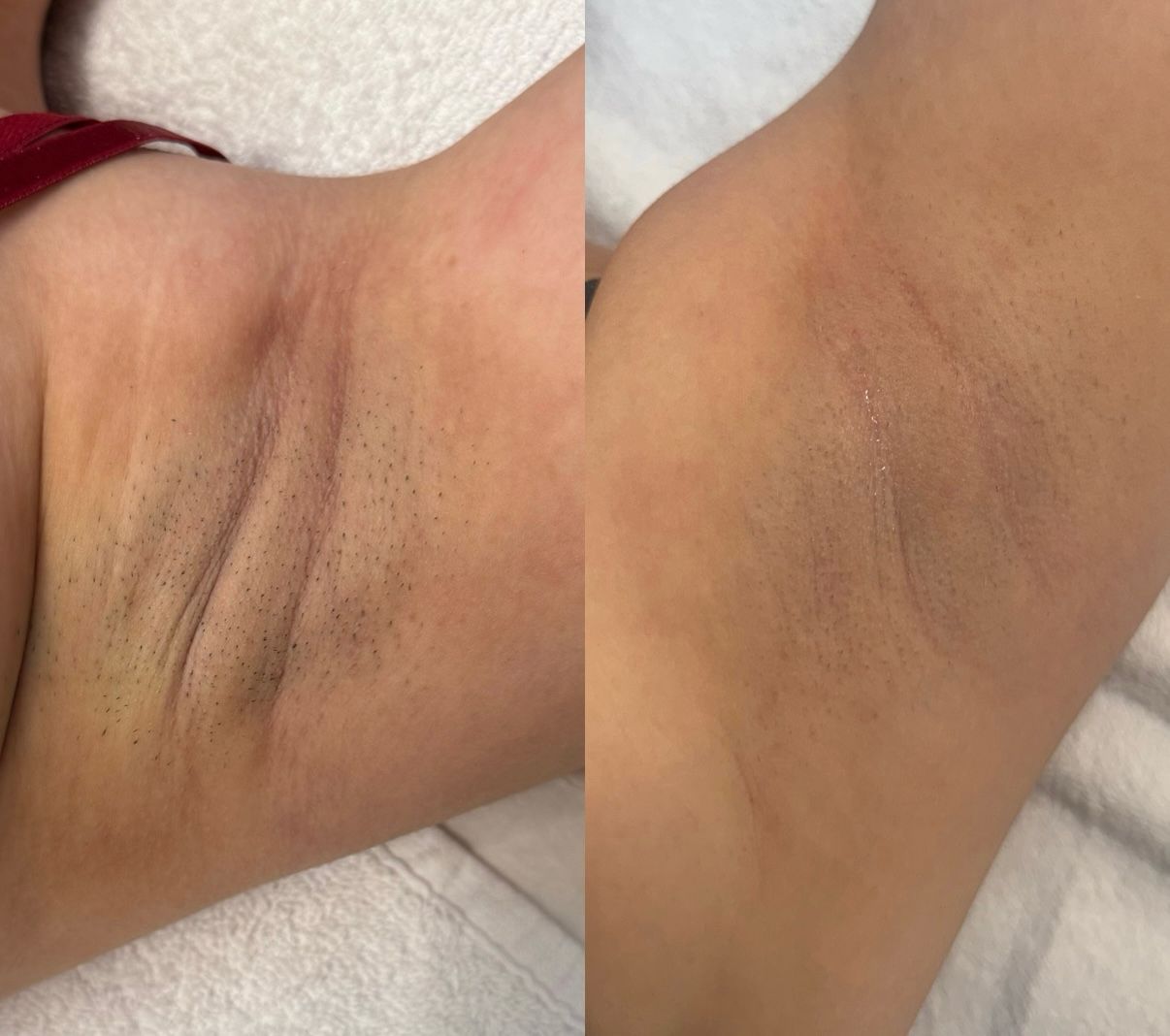 Antes e depois de depilação a laser na axila