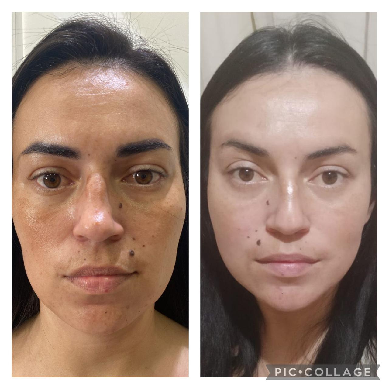 Antes e depois de Lavieen, uniformização do tom da pele