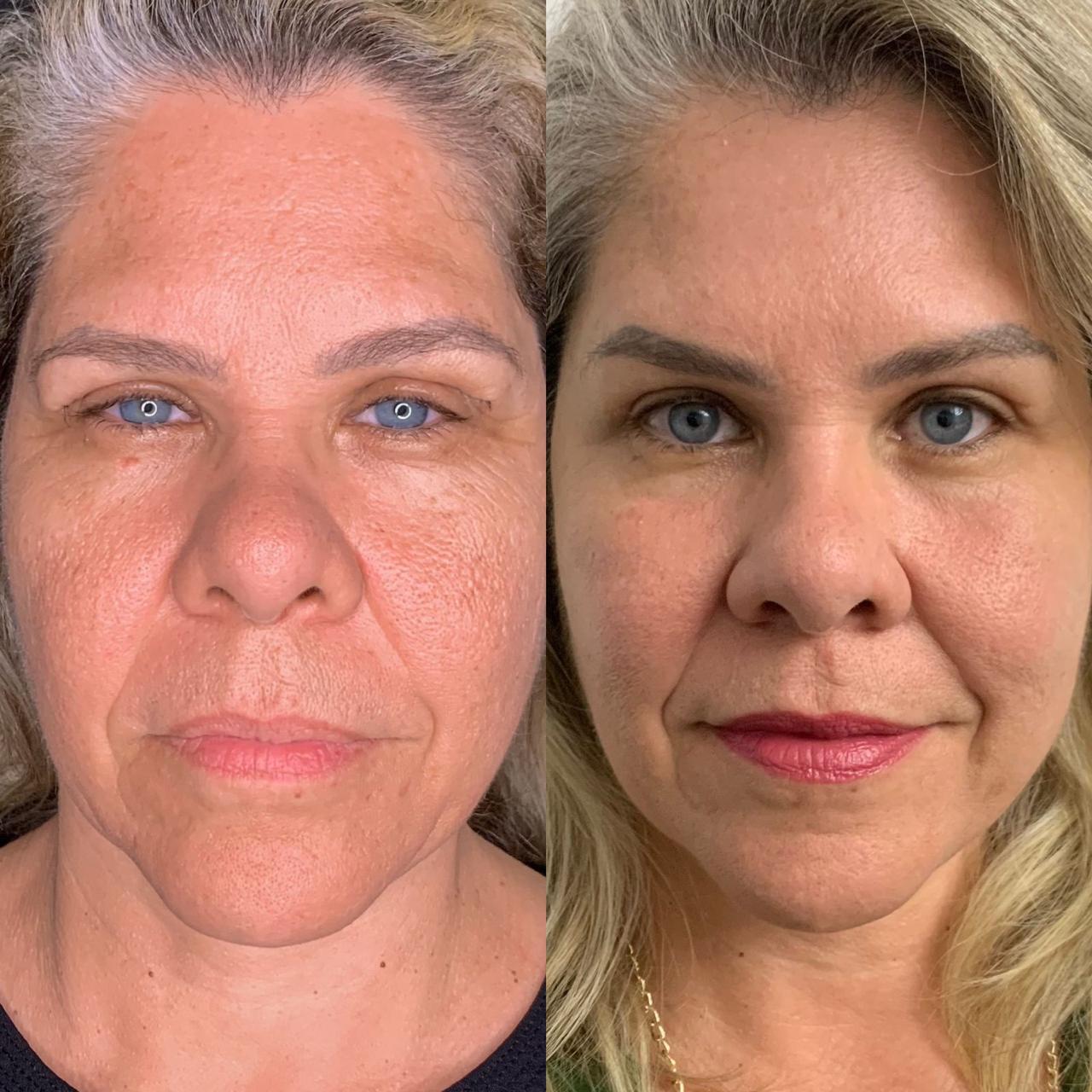 Antes e depois de Lavieen, redução de manchas