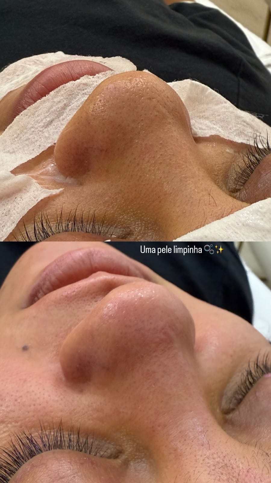 Antes e depois de limpeza de pele