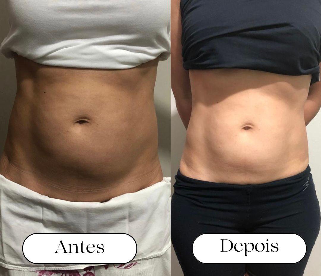 Antes e depois de Lipo LED no abdômen