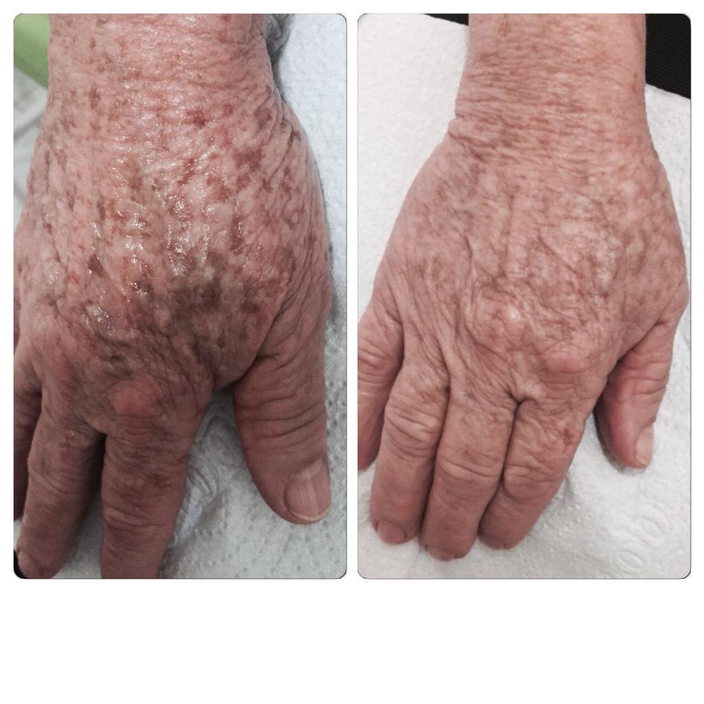 Antes e depois de luz intensa pulsada nas mãos