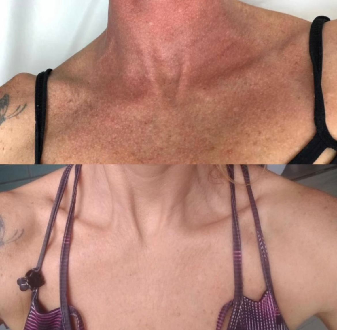 Antes e depois de luz intensa pulsada no colo