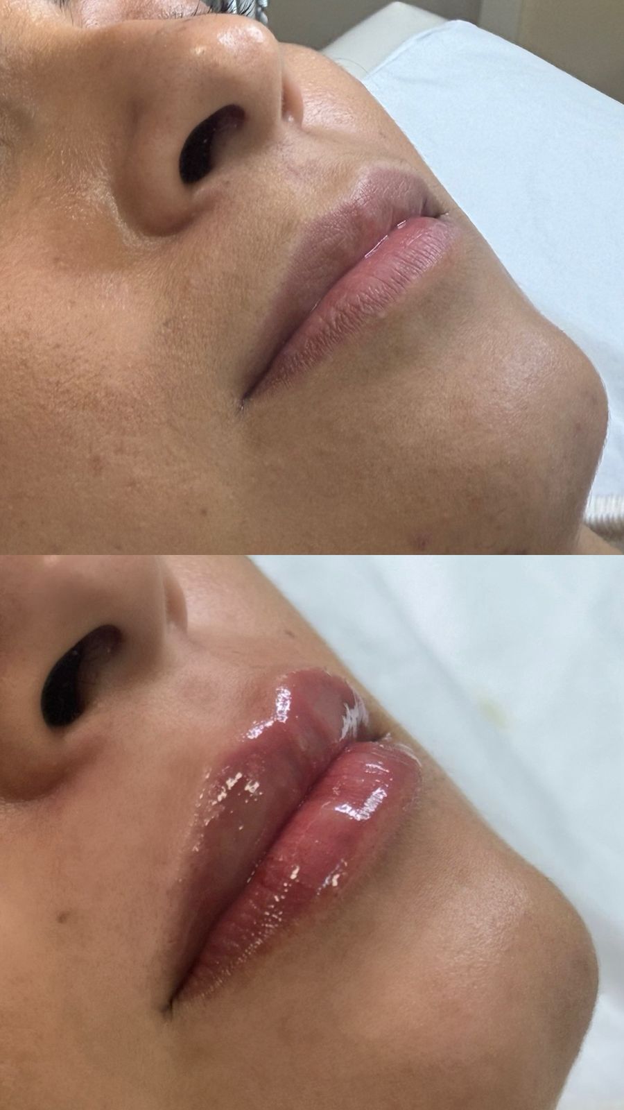 Antes e depois de preenchimento labial