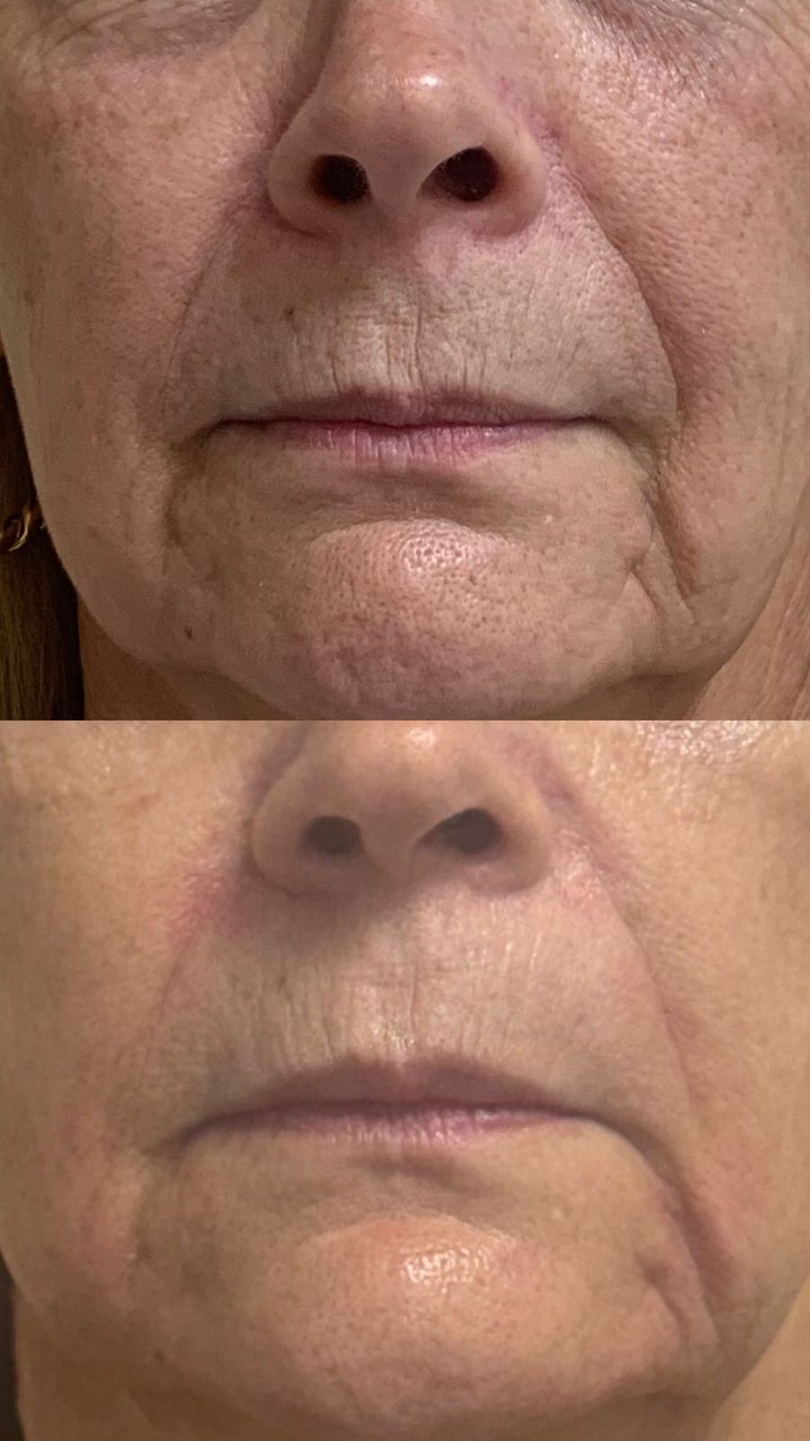Antes e depois de preenchimento na região perioral