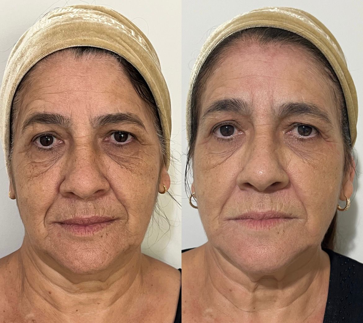 Antes e depois de Ultraformer no rosto e pescoço