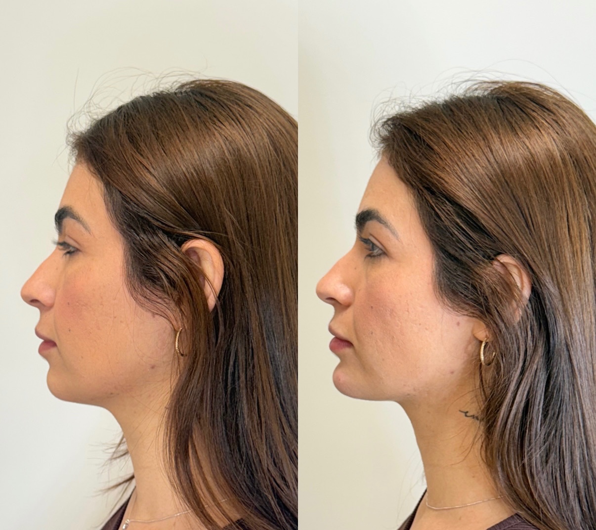 Antes e depois de Ultraformer, perfil facial